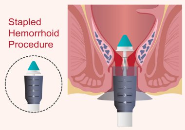Stapled hemoroidopexy prosedürü bir tür ameliyattır. 