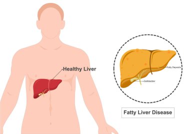 Yağlı karaciğer hastalığı bir hastalıktır..