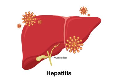 Hepatit, karaciğerin iltihaplanmasıdır.. 