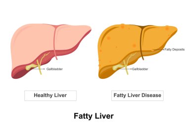 Normal Karaciğer ve Yağ Karaciğeri Hastalığı.