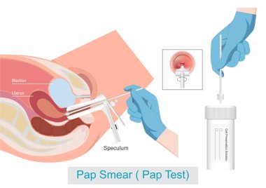 Pap Smear Servikal Kanser Taraması.