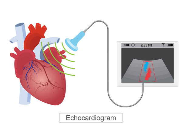 Эхокардиограмма (эхо) - это тест, который использует высокочастотные звуковые волны (ультразвук), чтобы сделать снимки сердца - это тест, который диагностирует и управляет сердечными заболеваниями.