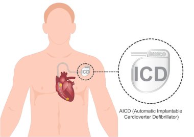 ICD ya da AICD, kalp ritmini normale döndürmek için elektriksel impulslar kullanan küçük pille çalışan bir cihazdır.