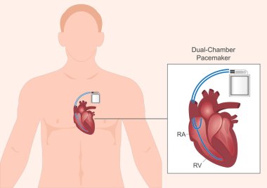 Çift katlı kalp pili. Her iki odanın kasılmalarının hızını düzenlemek için kalp pili. Tıbbi sağlık hizmetleri, vektör çizimleri..