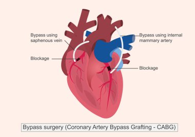 Bypass ameliyatı (Koroner Arter Baypas Grafting veya CABG): tek, çift, üçlü ve dörtlü kalp hastalıklarının tedavisinde kullanılan cerrahi bir işlemdir. Tıbbi sağlık hizmetleri.