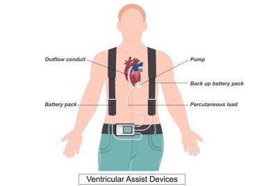 Ventriküler asist cihazı (VAD) kalbin alt odalarından vücudun geri kalanına kan pompalamaya yarayan bir cihazdır. Zayıf kalp ya da kalp yetmezliği için bir tedavi.