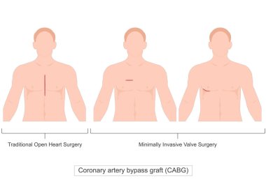 Koroner arter bypass grefti (CABG) koroner kalp hastalıklarının tedavisinde kullanılan cerrahi bir işlemdir. Kan akışını ve tıbbî akışı iyileştirmek için ana arterlerin daralmış ya da tıkanmış kısımlarındaki kanı yönlendirir.