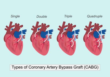 Bypass ameliyat türleri (koroner arter bypass Grafting veya CABG): tek, çift, üçlü ve dörtlü kalp hastalıklarının tedavisinde kullanılan cerrahi bir işlemdir. Tıbbi sağlık hizmetleri.