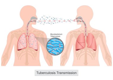 Tüberküloz bir insandan diğerine hava yoluyla yayılır. Tüberküloz bakterisi, akciğer ya da boğaz hastalığı olan birinin öksürmesi, hapşırması, konuşması ya da şarkı söylemesi sonucu havaya karışır..