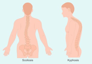 Kyphosis ve skolyoz hem omurilik durumlarıdır, ama omurilik eğriliği yönünde farklılık gösterirler. Sağlık hizmeti, Vektör illüstrasyon.