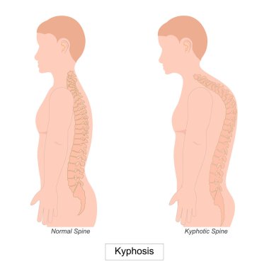 Kyphosis omuriliğin ileri doğru aşırı bir eğrisidir. Bu durum kamburlaşmak gibi öne doğru eğilmeye neden olabilir. Ağrıya neden olabilir. Sağlık sigortası, vektör illüstrasyonu..