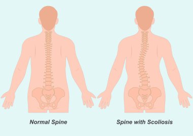 Skolyoz omurganın yan eğrisidir. Bu, vücudun doğal ön ve arka eğrisinden farklıdır. Sağlık hizmeti, Vektör illüstrasyon.