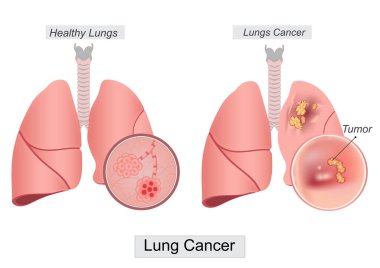 Akciğer kanseri, akciğer kanseri olarak da bilinen akciğer kanseri dokusunda oluşan ve akciğerde başlayan kötü huylu bir tümördür. Sağlık hizmetleri, vektör illüstrasyonu.