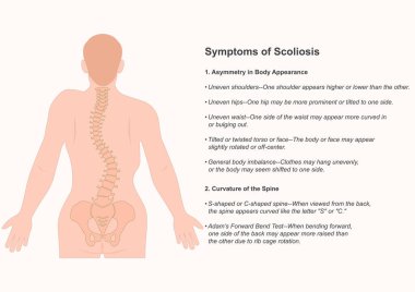 Skolyoz belirtileri, omurganın yana doğru kıvrılıp bükülmesidir. Düzensiz omuzlar ve kürek kemikleri. Tıbbi sağlık hizmetleri, vektör illüstrasyonu..