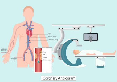 Koroner anjiyogram CAG, Floroskopi Makinesi (C-kolu veya Biplane Cath Lab) tarafından kalbin kan damarlarına bakmak için X ışınlarını kullanan bir testtir.. 