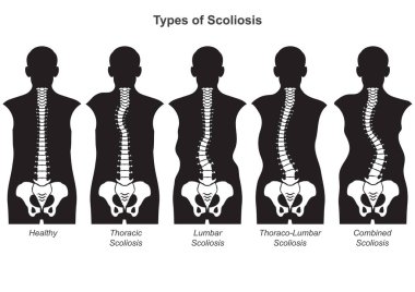 Skolyoz, omurganın arka tarafından bakıldığında genellikle 