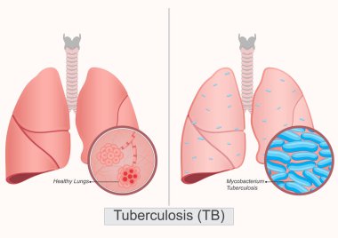 Tüberküloz (tüberküloz) ciddi bir bulaşıcı hastalıktır. Bu hastalığa Mycobacterium tüberküloz adı verilir ve enfekte bir kişi öksürdüğünde, hapşırdığında veya şarkı söylediğinde havaya yayılır.