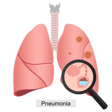 Zatürree, öncelikle alveol olarak bilinen küçük hava keselerini etkileyen akciğerin iltihaplı bir durumudur..
