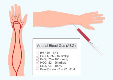 Arteriyel kan gazı (ABG) testi kandaki oksijen ve karbondioksit seviyelerini ve kandaki pH dengesini ölçer. Tıbbi sağlık hizmetleri, vektör çizimi.