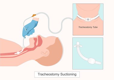 Trakeal Vakum vakum, vakum kateteri yoluyla negatif basınç uygulayarak salgı veya mukus solunum yolunu temizlemenin bir yoludur. Trakeostomi vakumu. Tıbbi sağlık hizmetleri.