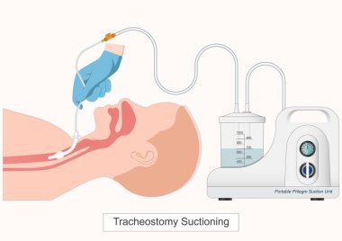 Trakeostomi tüpünü vakumlamak öksürükle temizlenemeyen mukus ve salgıları yok eder. Trakeostomi vakumu. Sağlık hizmetleri, vektör illüstrasyonu.