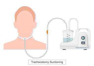 Trakeostomi vakumu, solunum yolunu açık tutmak ve nefes darlığını önlemek için trakeostomi tüpünden mukus ve salgıları temizlemek ve solunum yolunu açmak için yapılan bir prosedürdür.