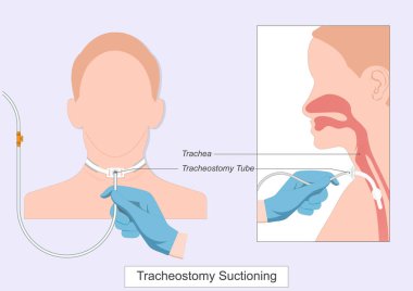 Trakeostomi vakumu mukusu temizler ve salgılar öksürükle temizlenemez. Solunum yolunu açar ve daha iyi nefes almaya yardımcı olur. Tıbbi sağlık hizmetleri, vektör illüstrasyonu..