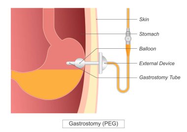 Gastrostomi, beslenme desteği için mideye gastrostomi tüpü yerleştirilen bir prosedürdür. PEG tüpü. Tıbbi sağlık vektörü çizimi.
