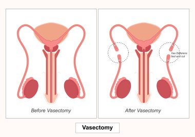 Vazektomi, sperm taşıyan tüpler (sperm taşıyan tüpler) kesilen veya mühürlenen erkeklerde kalıcı doğum kontrolü için yapılan bir cerrahi prosedürdür..