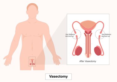 Vazektomi, sperm girmesini önlemek ve gebeliği önlemek için sperm deferenlerini kesip mühürlemeyi içeren erkek doğum kontrolünün kalıcı bir metodudur.. 