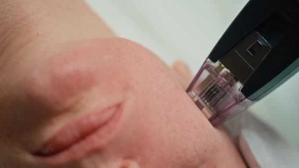 Advanced Beauty Treatment Micro Needling Therapy Rejuvenating Mature Skin Cosmetology — Stock Video