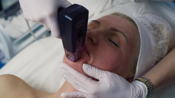 정밀도 Hyperpigmentation 염증성 여드름 포스트 확대한 숨구멍의 표적으로 처리를 고주파 — 비디오