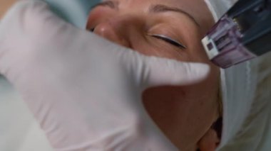 RF Microneedling Therapy: Cilt Bakımı ve Hedeflenmiş Cilt Yenilenmesi İçin Asgari İstilacı Tedavi. Yüksek kalite 4k görüntü
