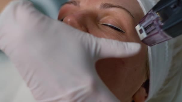 射频微修整疗法 微创疗法治疗皮肤摘除和有针对性的皮肤修复 高质量的4K镜头 — 图库视频影像