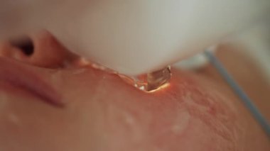 Makro video kozmetolojideki pigment lekelerini temizliyor. Yüksek kalite 4k görüntü