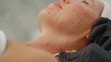 Bir kozmetikçi bir kadın üzerinde biyo-evrim işlemi gerçekleştirir. Kozmetolojide bir kızın yüzüne iğne yapmak. Yüksek kalite 4k görüntü