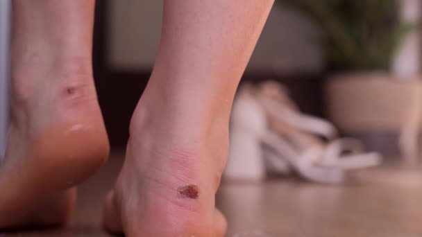 不快な靴のために女性の足にブリスト 足の健康のための適切な履物の重要性を強調する足のケアの概念 — ストック動画