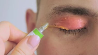 Göz enfeksiyonu ve konjonktivite bağlı kırmızı göz. Göz enfeksiyonlarını önlemek için lens bakımı ve diğer lens bakımında hijyenin önemini vurgulamak.