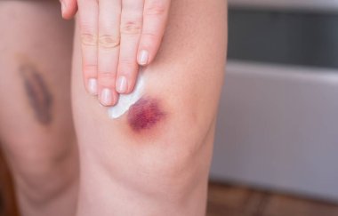 Kadın vücudundaki çürükleri tedavi ediyor. Stres ve yorgunluk vücudu zayıflatır, kan dolaşımını etkiler ve deriyi daha duyarlı hale getirir..