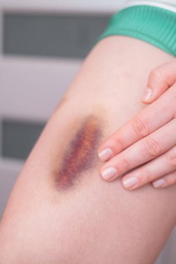 Göze çarpan çürükleri olan kadın bacakları vitamin eksikliği veya zayıf kan damarları belirtisi olabilir..