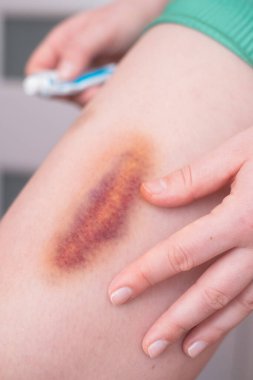 Kadının bacağında çürük izleri var. Tamamen iyileşmek ve ortadan kaybolmak için zaman gerekiyor..