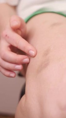 Çoklu çürükleri olan kadın bacakları, yaralanma ya da dolaşım sorunları, deri sağlığı üzerindeki etkisini gösteriyor. Yüksek kalite 4k görüntü