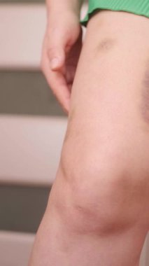 Bacaklardaki çürükler iyileşmek ve düzgün bir şekilde kaybolmak için zaman gerektiren tümseklerin genel belirtileridir. Yüksek kalite 4k görüntü