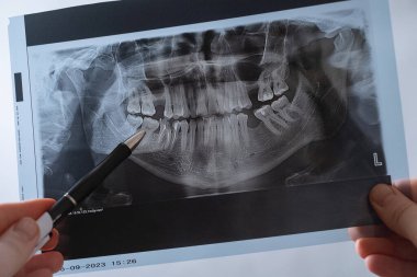 Doktor hasta için en iyi tedavi yöntemini belirlemek için diş röntgenini inceler..