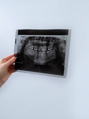 Modern diş teknolojisi: X-ray dişçinin gizli sorunları tespit etmesine ve etkili bir tedavi planlamasına yardımcı olur.