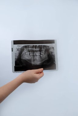 X-ray resmi doğru diş muayenesi ve teşhisi için temel bir araçtır.