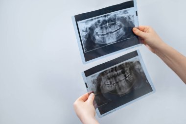 Diş sorunlarının erken teşhisi: Dişçi hastanın dişlerindeki değişiklikleri doğru teşhis için röntgen görüntüleriyle değerlendirir.