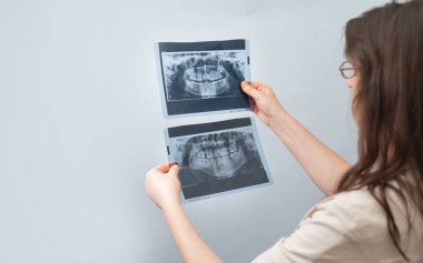 Tedavinin farklı aşamalarında çekilmiş görüntüleri karşılaştırmak dişçinin diş sorunlarının ilerlemesini anlamasına yardımcı olur.