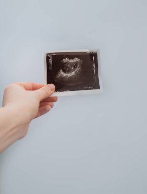 Kadın doğum uzmanı-jinekolog, gelecekteki hamilelik için en iyi çözümü sunmak amacıyla ultrasonu dikkatlice inceliyor..