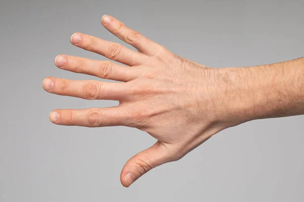 Caso Polidactilia Acercamiento Mano Del Hombre Con Hexadactilia Seis Dedos — Foto de Stock